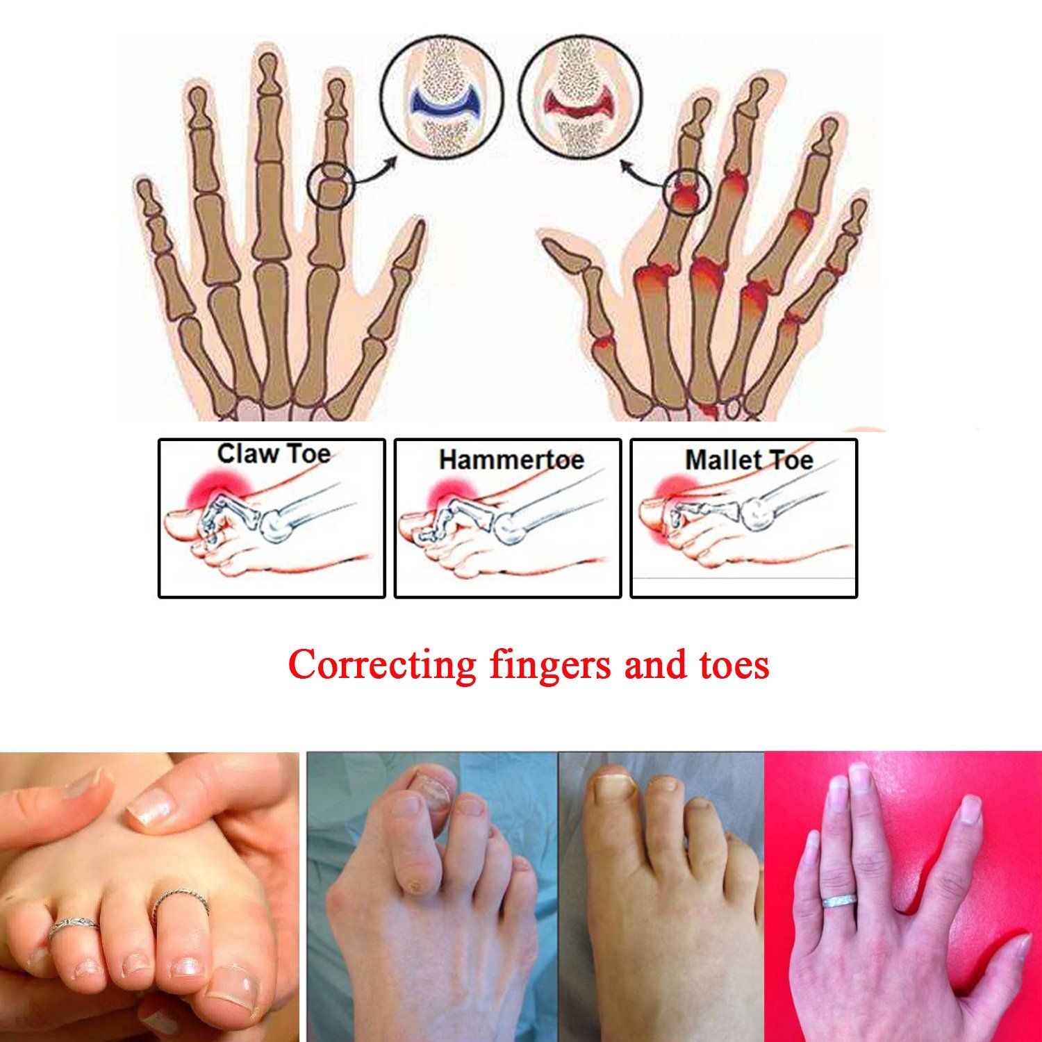 14 Pieces Broken Toe Wraps, Cushioned Bandages, Hammer Toe Separator Splints, Toe Straight, Hammer Toe Wrap, for Broken Toe