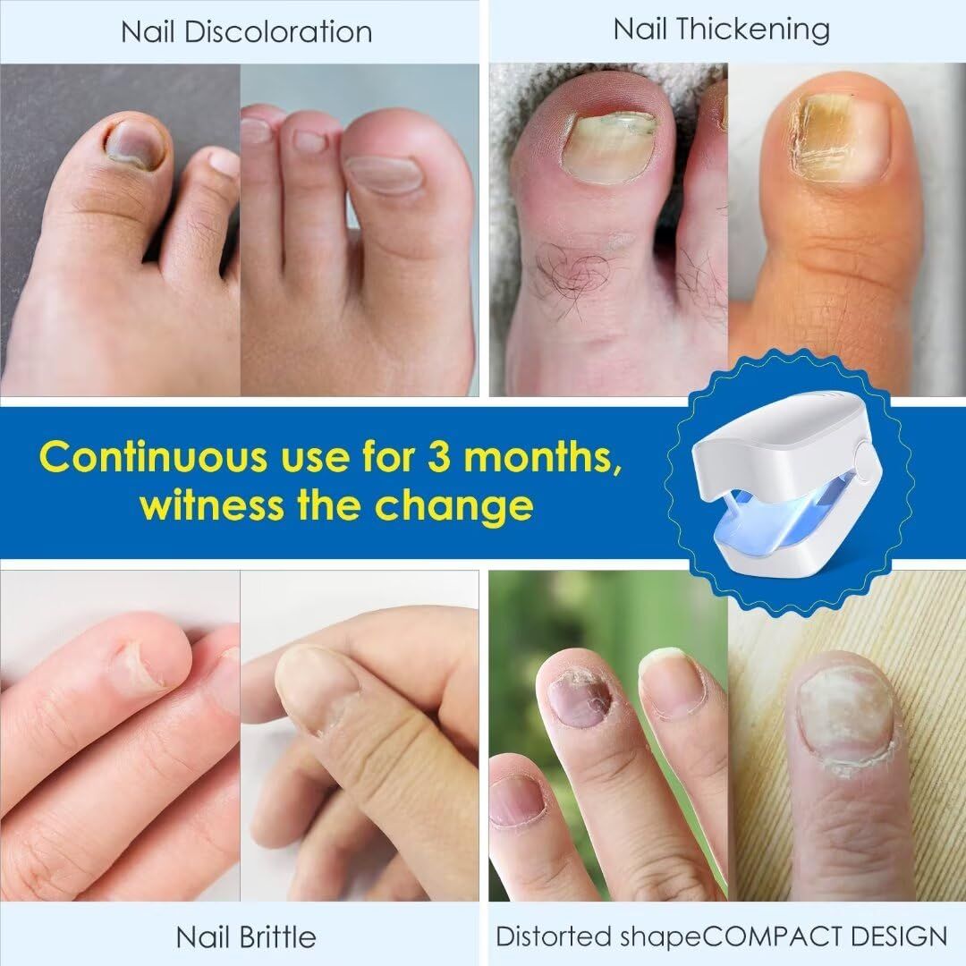 Nail Fungus Cleaning Light Device, FSA or HSA eligible Nail Fungus for Damaged Discolored Thick Toenails & Fingernails โ image 4