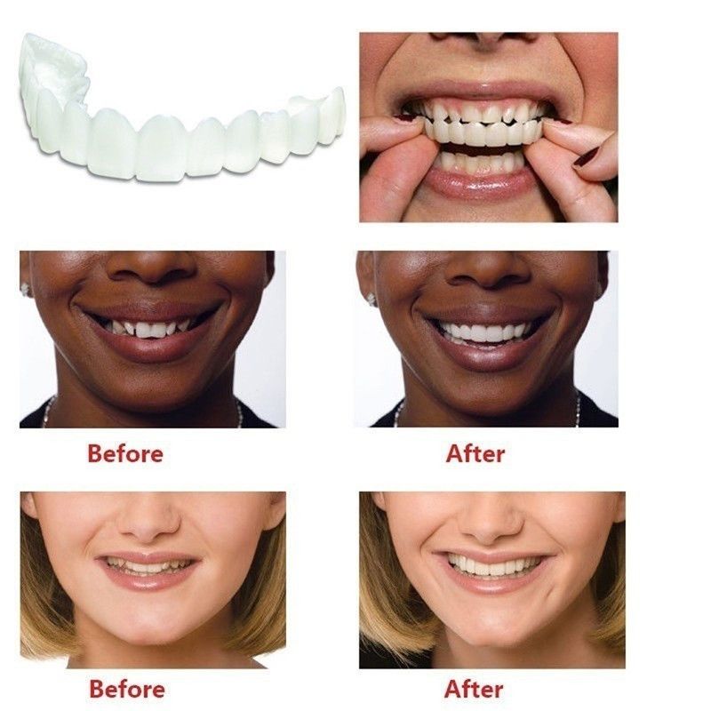 Fake Teeth Denture Teeth Temporary Snap On Veneers Cover The Imperfect Teeth Fix Confident Smile Temporary Fake Teeth — image 4