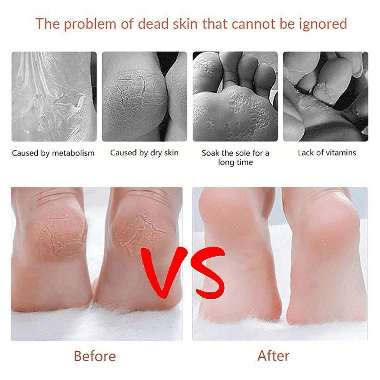 Foot Callus Shaver & Scraper Remover - Callous Removers for Feet Razor Tools with 10 Blades - Professional Pedicure Knife for Heel Hand Skin Care โ image 3